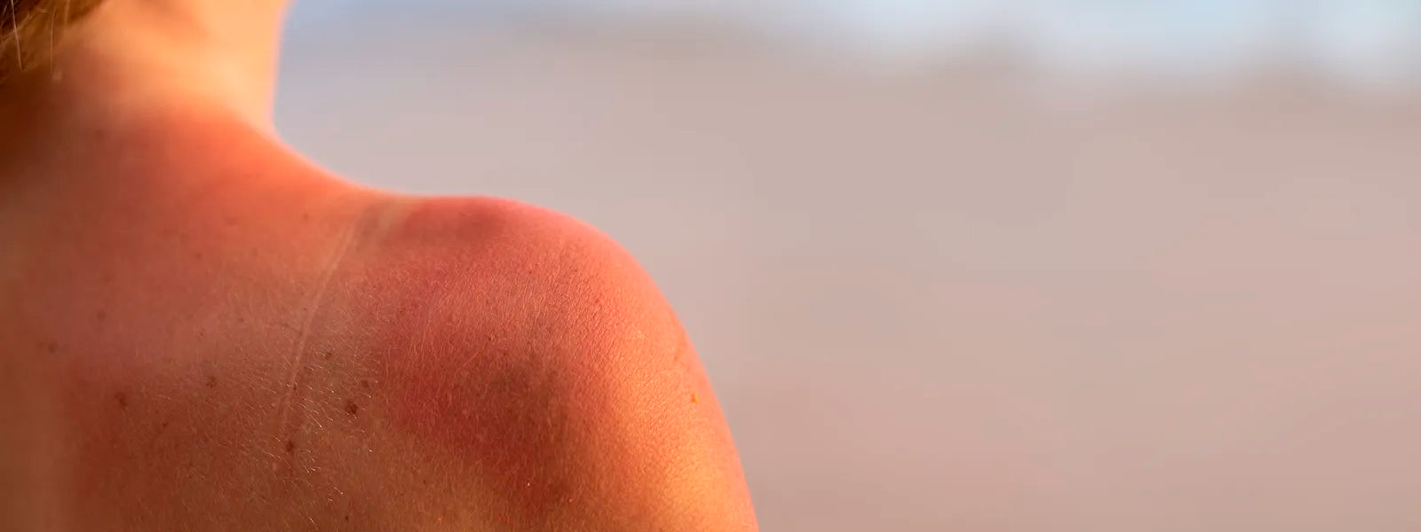 Sun Damage: What You Need To Know